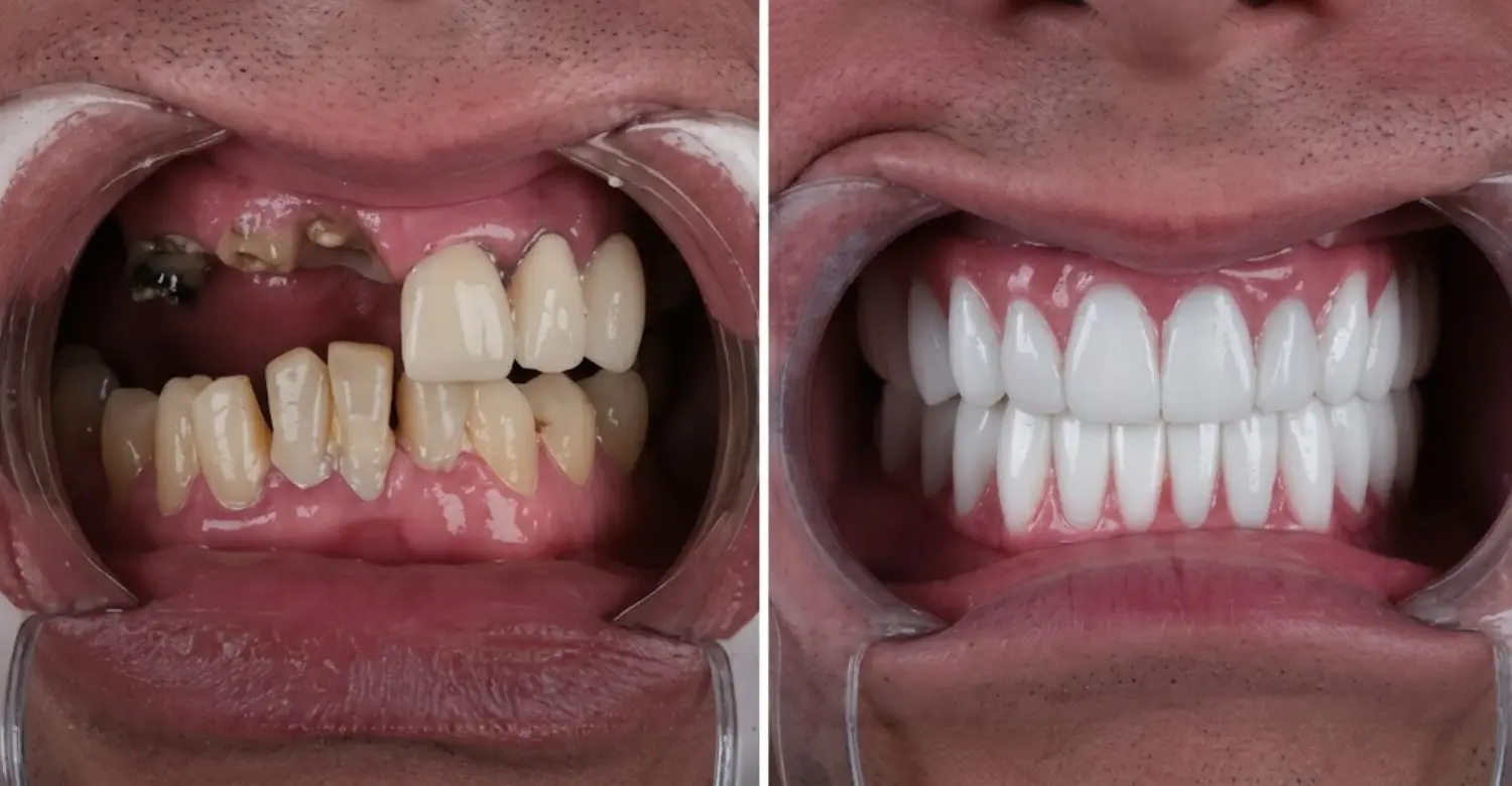 All on 6 Dental Implants Before and After Gallery 2